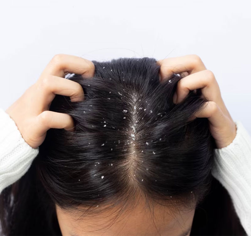 dandruff-treatment-img1-def