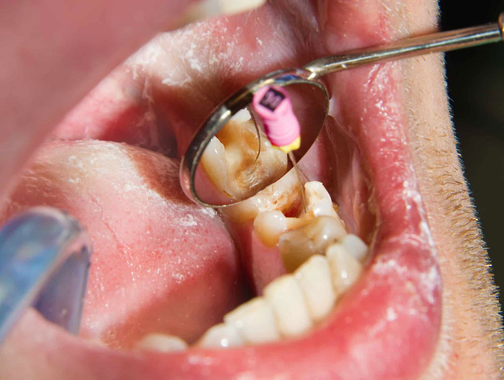 root-canal-treatment-img-drajayrana-2023