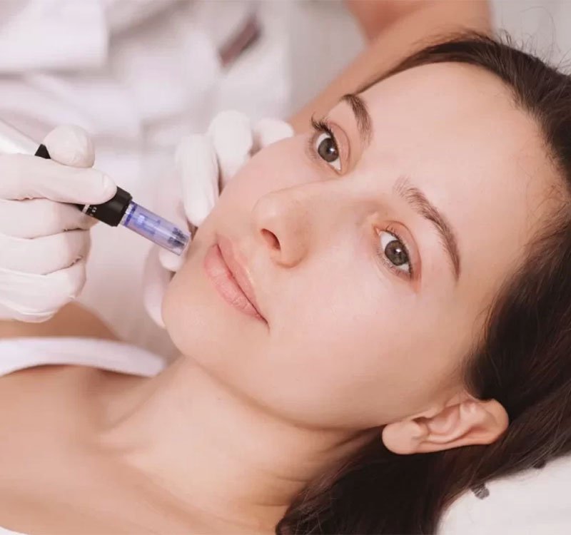 microneedling-img1-def